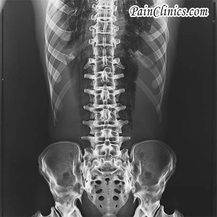 Xray Image Of Failed Back Surgery Syndrome