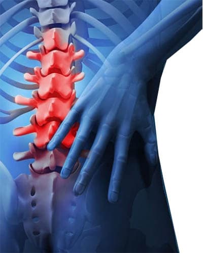 An X-ray style Image depicting Failed Back Surgery Syndrome